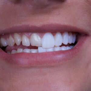 veneers veneers