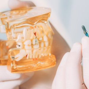 Dental Implants Dental Implants