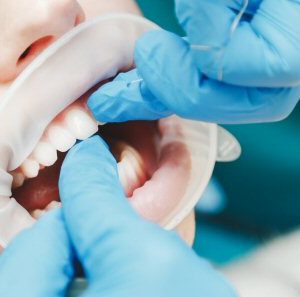 full mouth full mouth